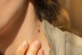 Skin Tag Removal